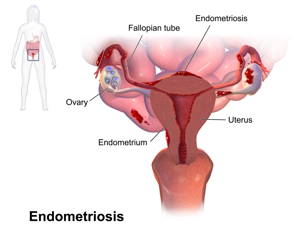endometriosis excision surgery